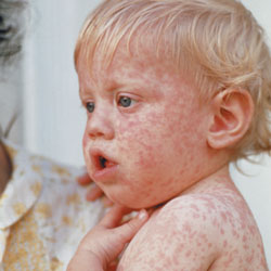 paracetamol for newborn rubella  How  Chemist Druggist spot measles and to mumps,